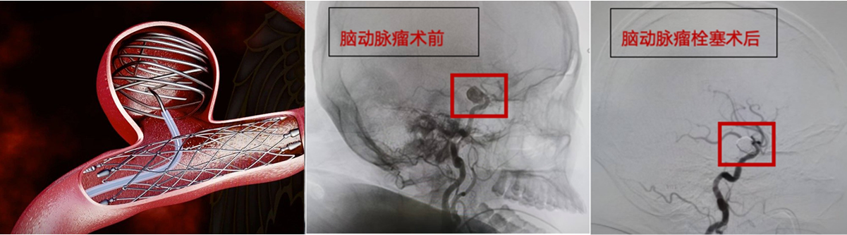 脑动脉整改之后